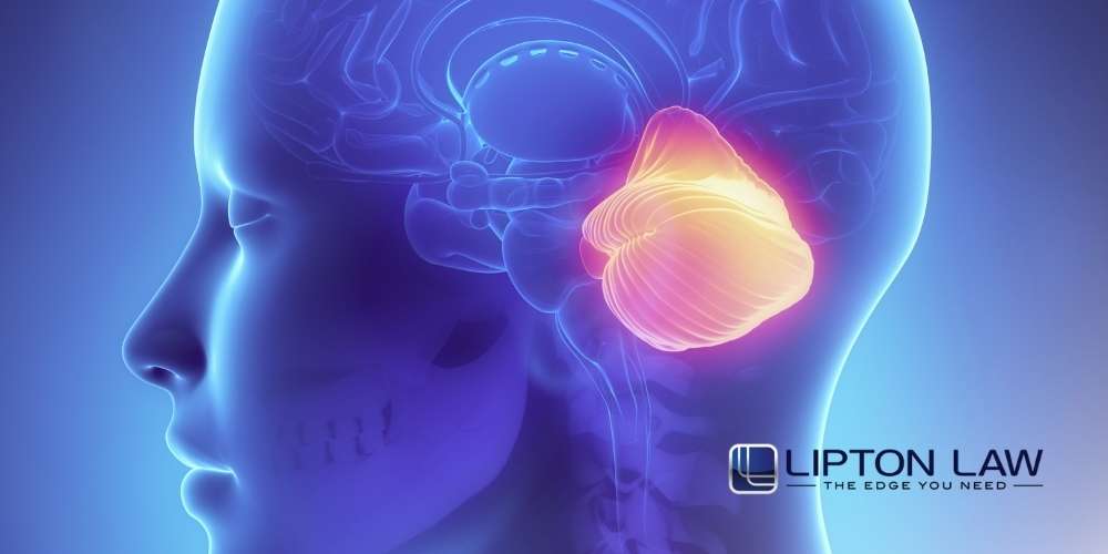 michigan stroke misdiagnosis attorney