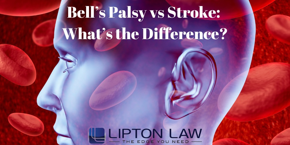 bell's palsy vs stroke