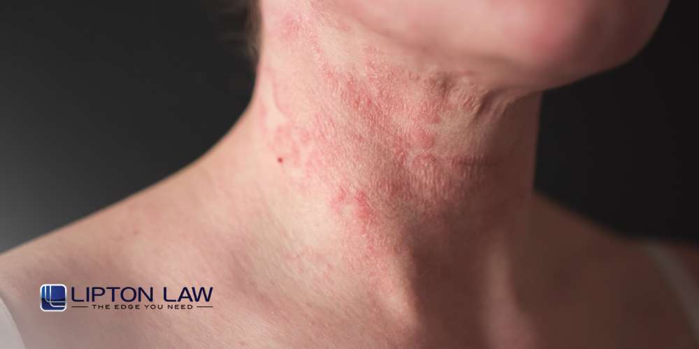 dupixent lawsuit