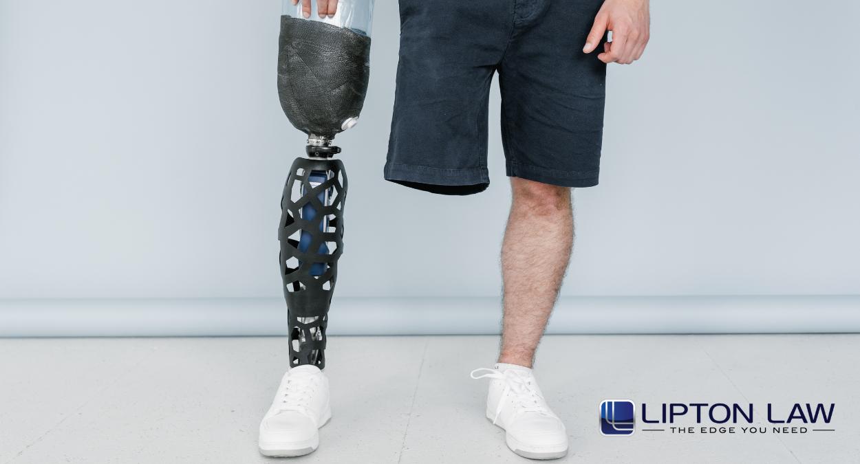 Below knee amputation attorney michigan