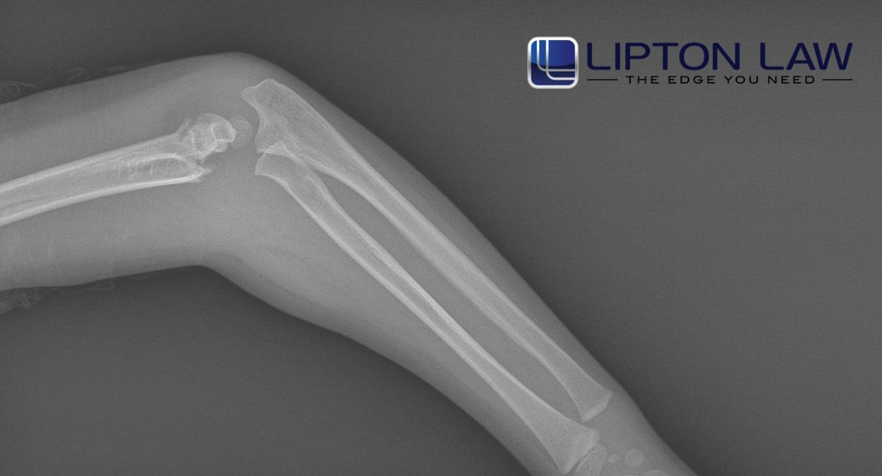 Michigan Broken Bone Injury Lawyer