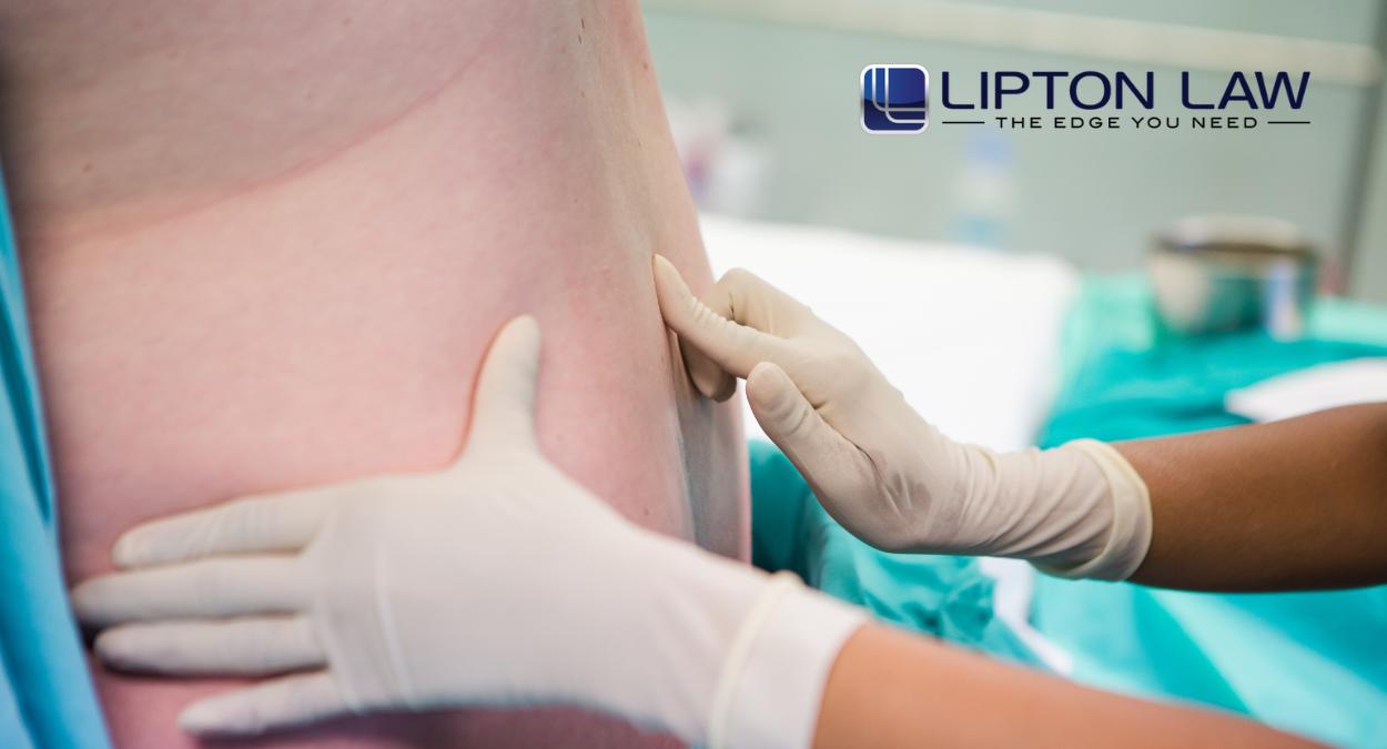Michigan Epidural Malpractice Lawyer