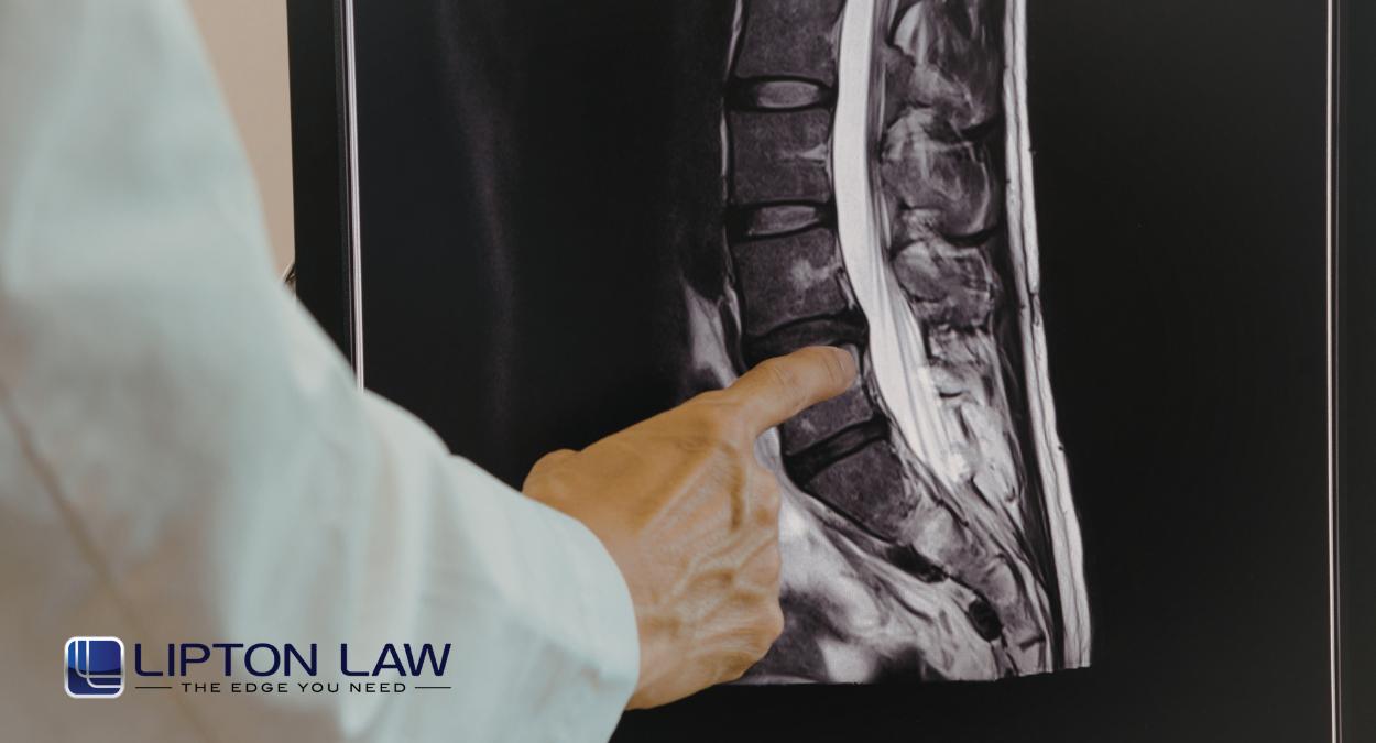 Southfield Cauda Equina Attorney