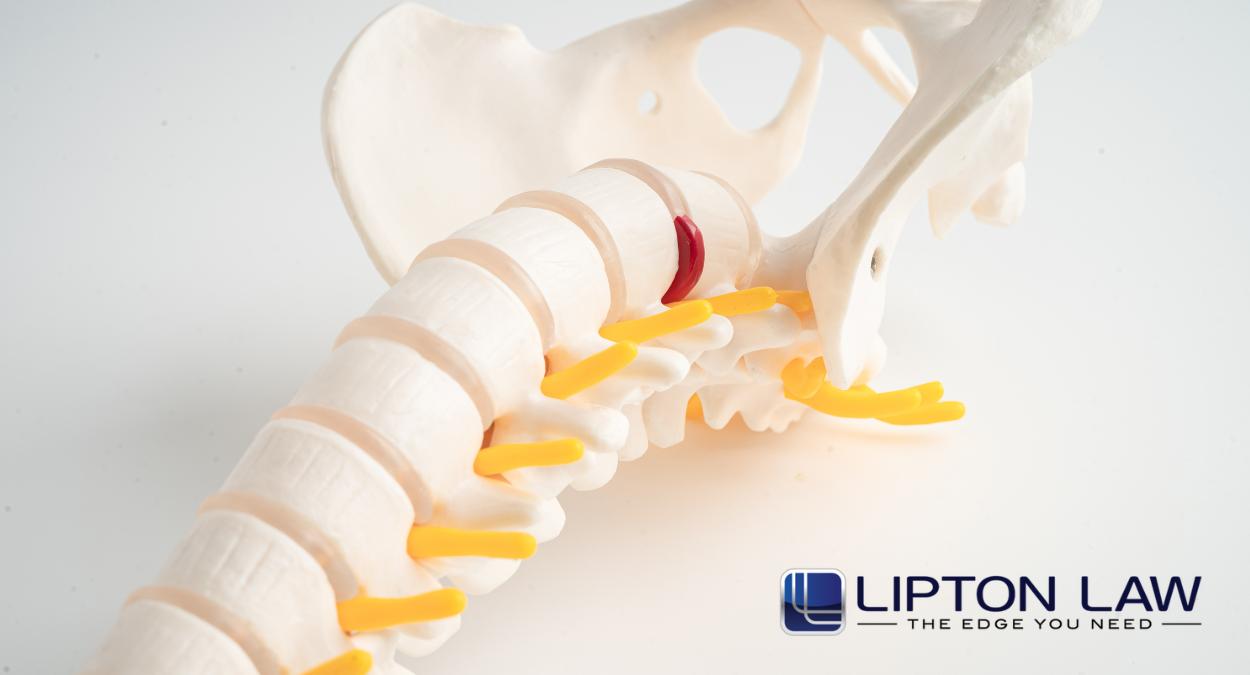 Spinal Cord Compression Injury Lawyer in Michigan | Lipton Law Spinal Cord Compression Injury Lawyer in Michigan | Lipton Law