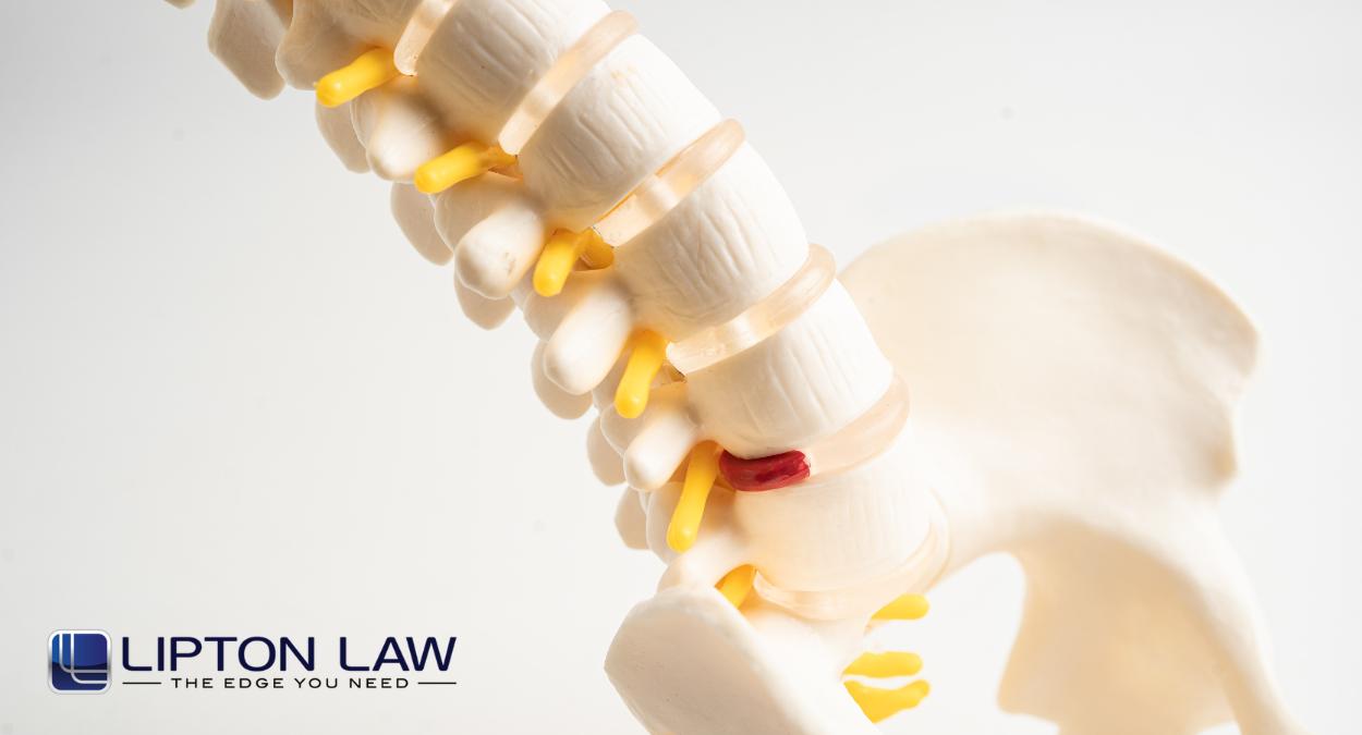 spinal cord compression injury