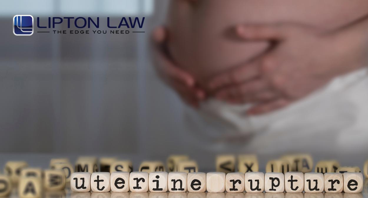 Uterine Rupture Injury Lawyer in Michigan